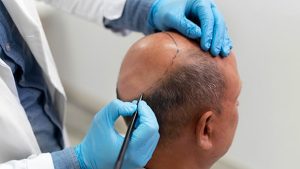 Before and after images of a successful hair transplant procedure at BlueMagic Group, demonstrating significant improvement in hair density and scalp coverage.