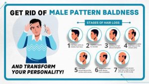 Overview of Male Pattern Baldness