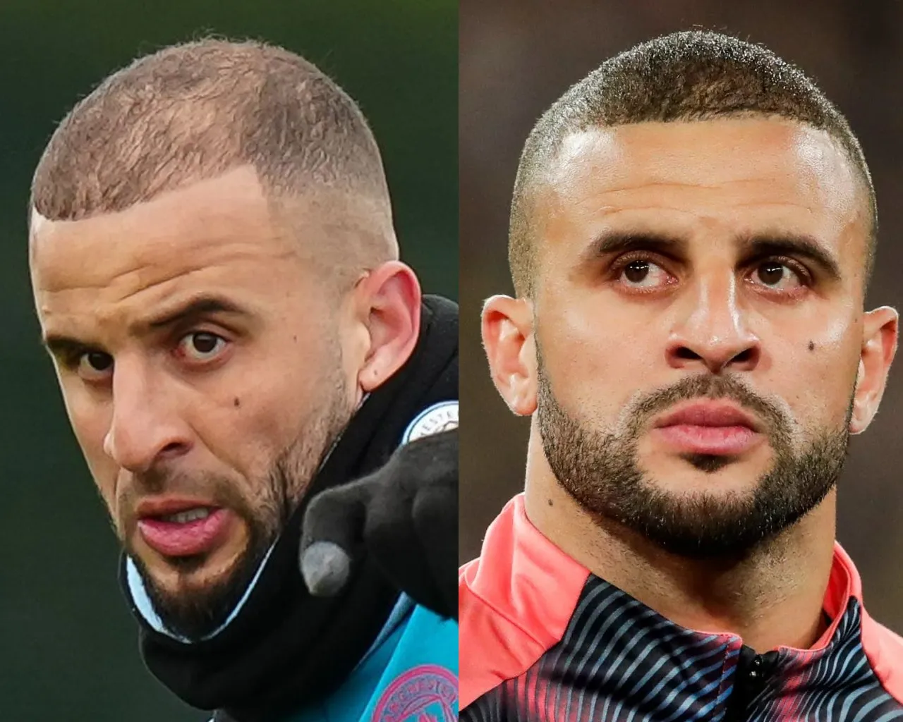 Kyle-Walker-hair-transplant